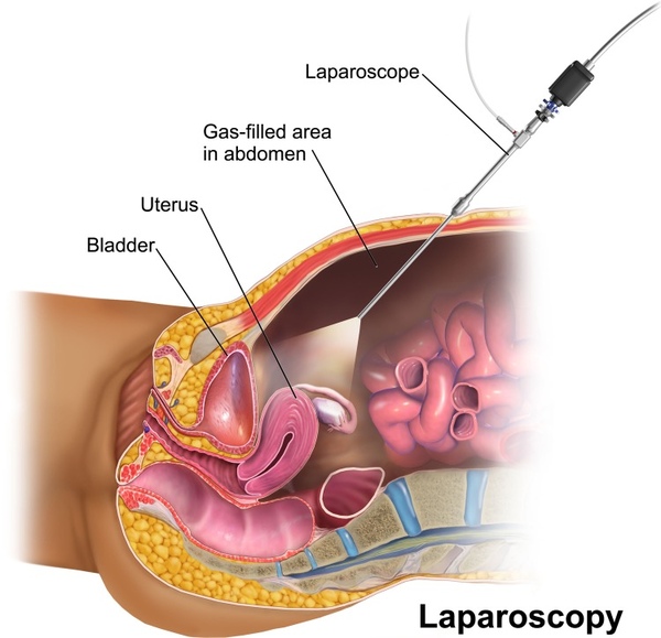 Лапароскопия - операции, которые невозможно сделать через разрез