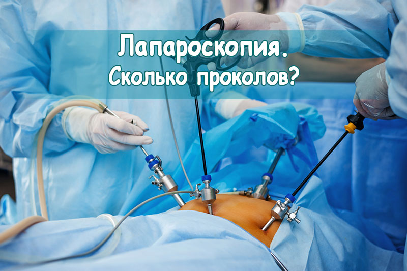 Лапароскопия в гинекологии. Сколько проколов?