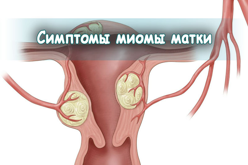 Симптомы миомы матки