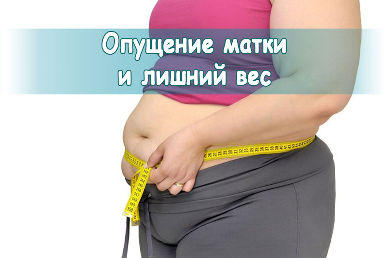 Опущение матки и лишний вес