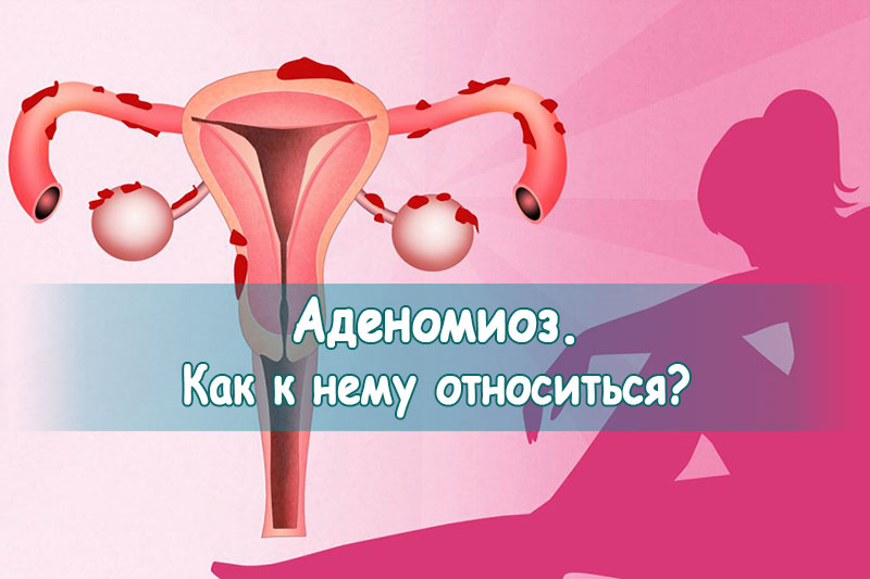 Эндометриоз матки (аденомиоз)
